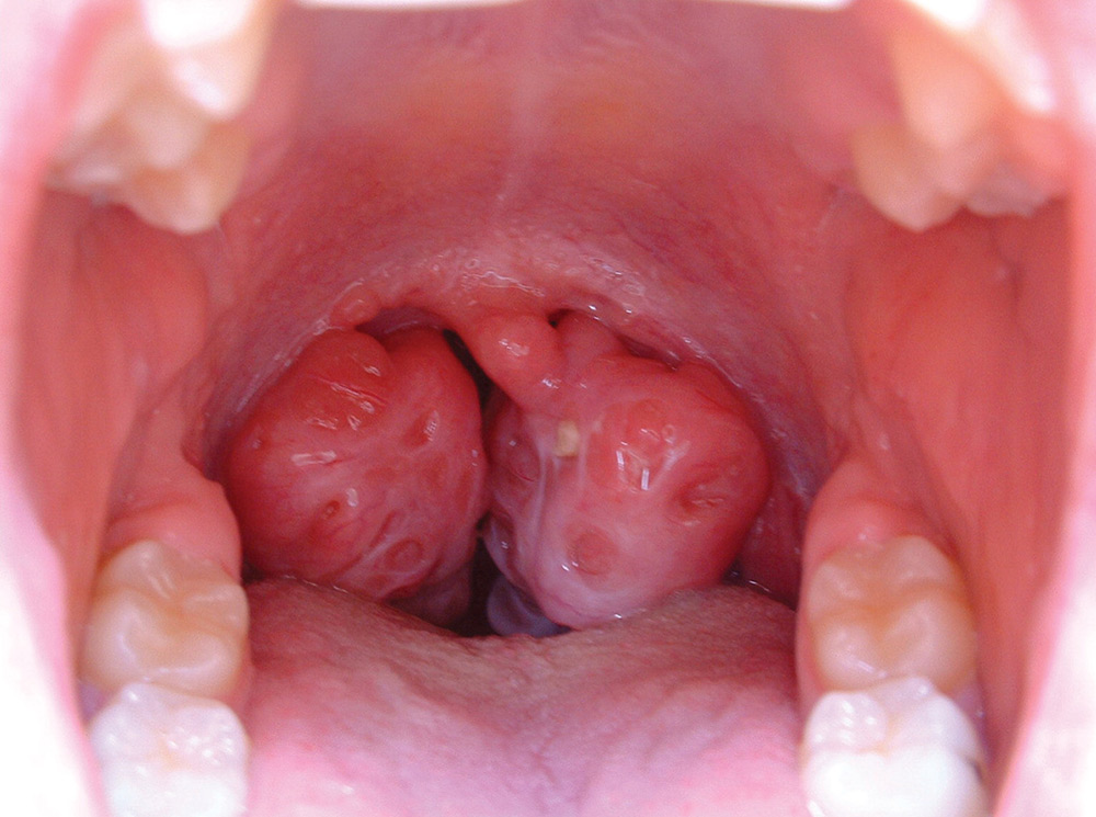 Enlarged Tonsils